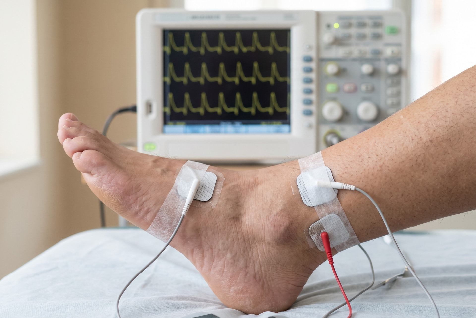 Electrodos de superficie colocados en el tobillo y el pie durante una estimulación nerviosa repetitiva