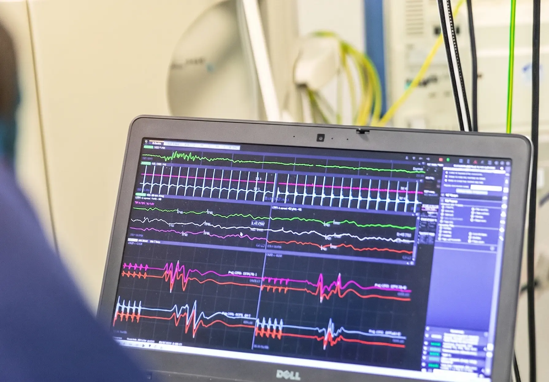 ¿Qué es la neuromonitorización en la cirugía de columna y cuándo se recomienda?