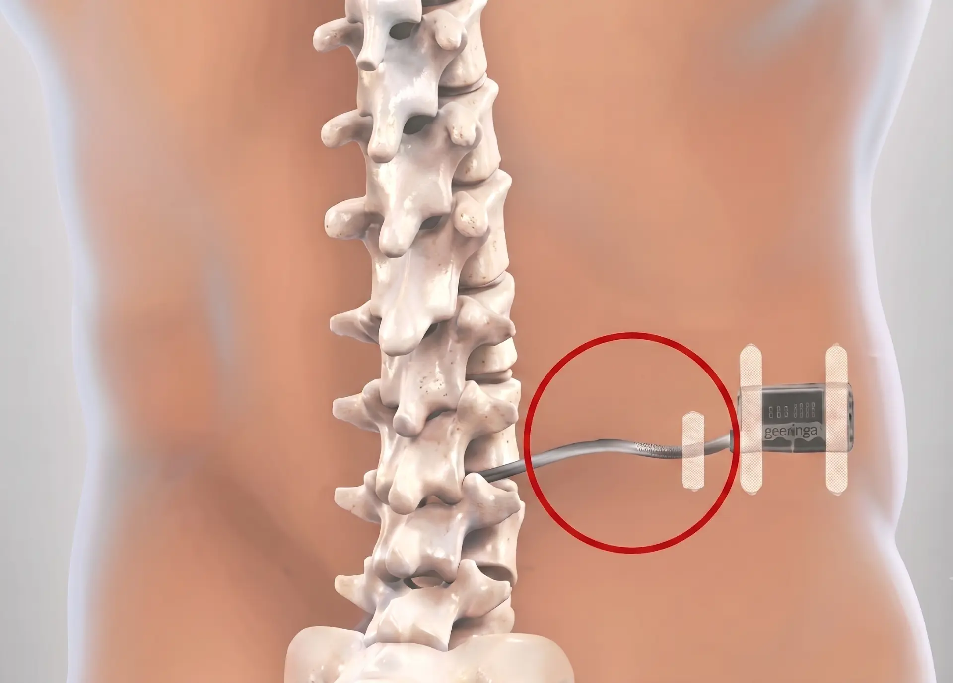 ¿En qué cirugías se recomienda el neuromonitoreo de médula espinal?